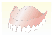 部分入れ歯と総入れ歯（形態上の違い）